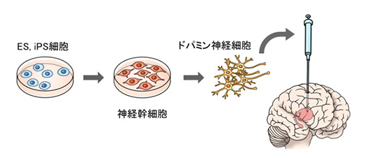 脳疾患治療の頂を目指す パーキンソン病に対するips細胞を用いたドパミン神経細胞移植療法 伝える Topics 医薬翻訳のアスカコーポレーション